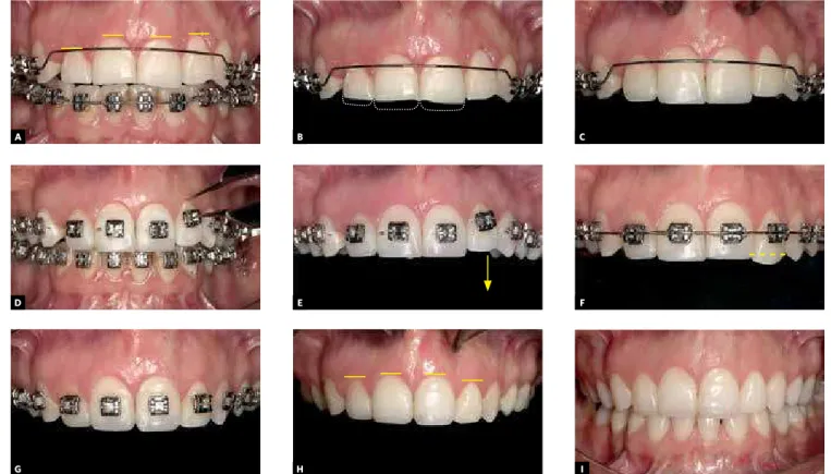 Figure 10 - A, B) Patient nearing completion of orthodontic treatment, showing uneven gingival contour in upper anterior region, and wear of incisal  edges of teeth #12, 11 and 21; C) provisional composite resin restorations established a new incisal silho