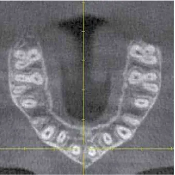 Figure 6 - An axial view of the root apices can give important information  about incomplete correction or torque discrepancy