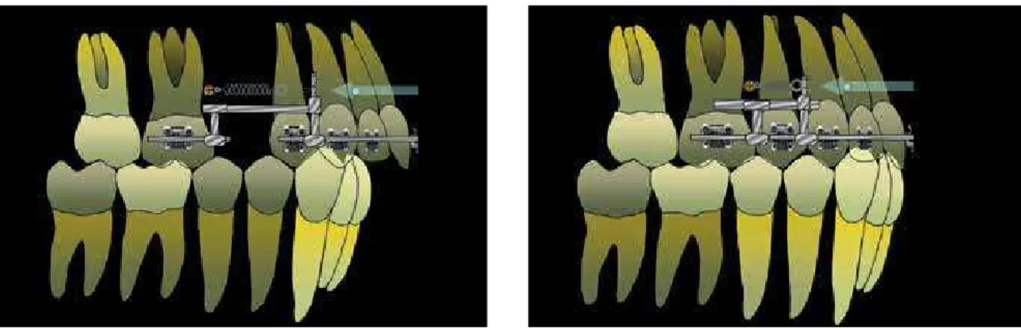 Figure 16 - Retraction of the upper anterior teeth when these are with ideal inclination.