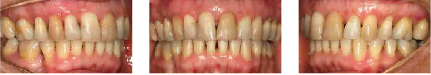 Figure 22 - End of retraction with midline and bilateral canine relationship corrected.
