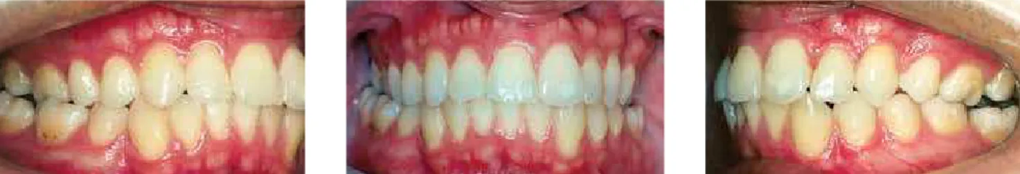 Figure 27 - Complete Class II malocclusion in the right side complete Class III in the left side, resulting from previous orthodontic treatment with  asymmetrical extractions.