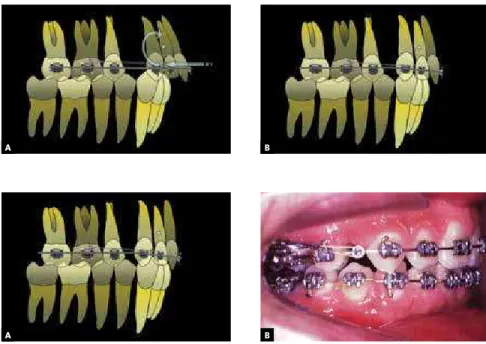 Figure 3 images show the difficulties usually found  in overjet correction. Anterior teeth inclination in the  beginning of treatment was slightly increased,  howev-er retraction magnitude, in this case assisted by  indi-rect anchorage with the palatal imp