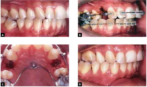 Figure 3 - Upper premolar extractions were  planned for correction of increased overjet (A,  B)
