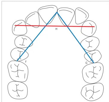 Figure 1 - Little’s Irregularity Index for the Upper Arch: Sum of the dis- dis-tances A+B+C+D+E.