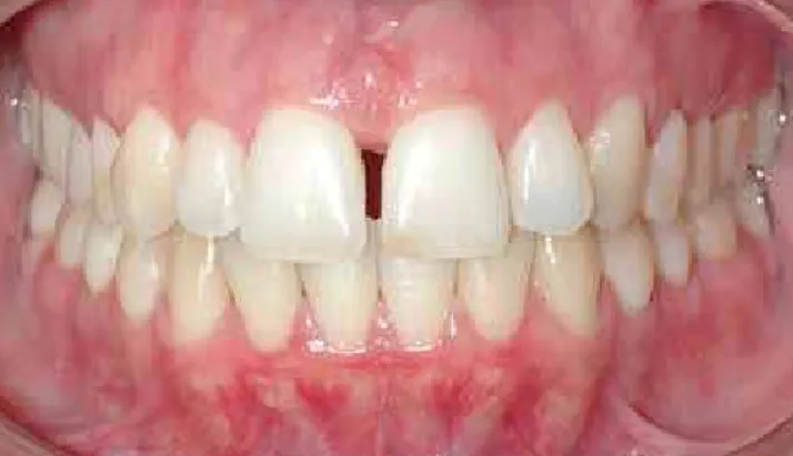 Figure 1 - Example of anterior superior diastema relapse. Photograph ob- ob-tained 10 years after removing the superior Hawley retainer.