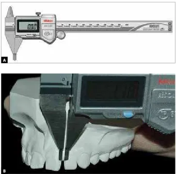Figure 2 - A) Digital caliper Mitutoyo used to measure interincisor spac- spac-ing. B) Diastema measurement method.