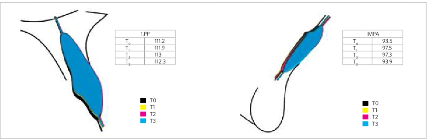 Figure 5 - Cephalometric superimposition of IMPA and 1.PP evolution from initial leveling up to 0.021 x 0.025-in archwire