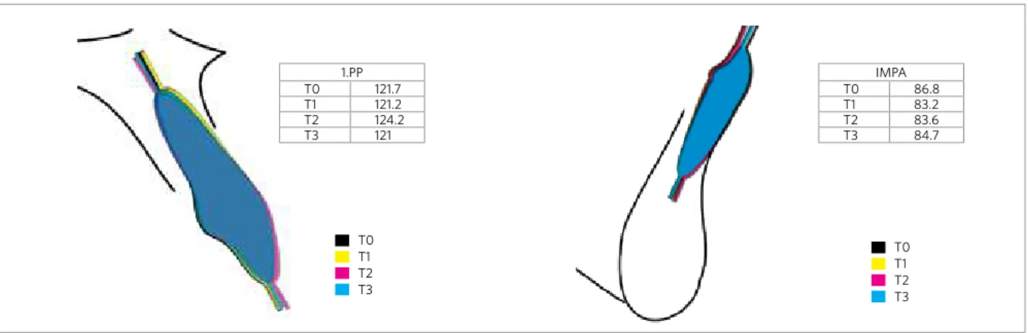 Figure 3 - Cephalometric superimposition of IMPA and 1.PP evolution from initial leveling up to 0.021 x 0.025-in archwire