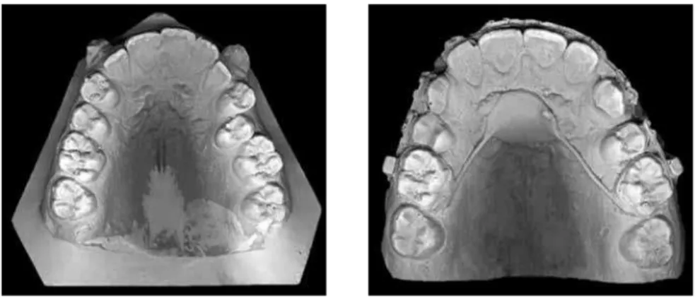 Figure 2 - Upper models (baseline and post  canine initial retraction) were scanned  sepa-rately for each patient.