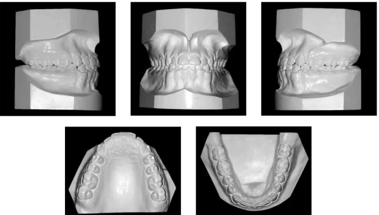 Figure 10 - Two years and two months post-treatment casts.