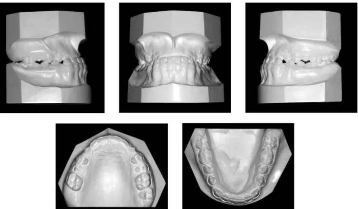Figure 2 - Initial casts.