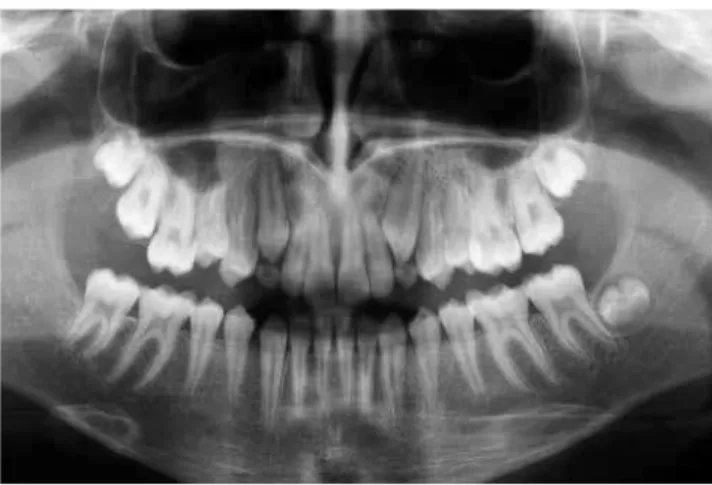 Figure 4 - Initial lateral cephalometric radiograph and cephalometric tracing.