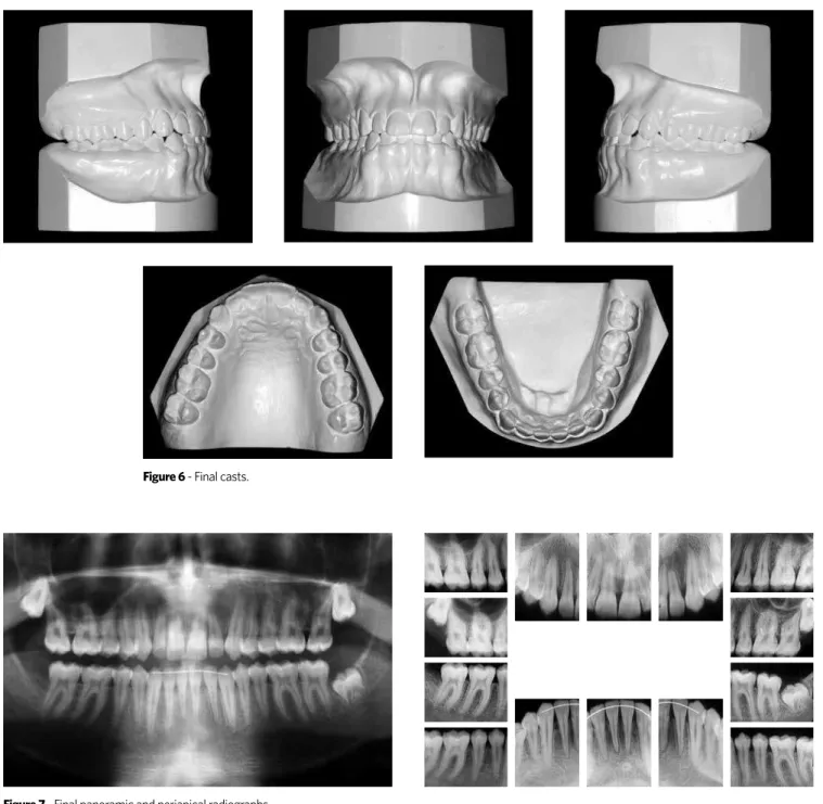 Figure 6 - Final casts.