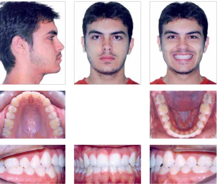 Figure 9 - Two years and two months post-treatment facial and intraoral photographs.