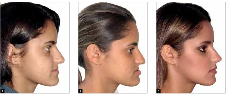 Figure 25 - Clinical follow up of facial profile with lips at rest: A) Initial, B) pre-operative and C) post-operative.