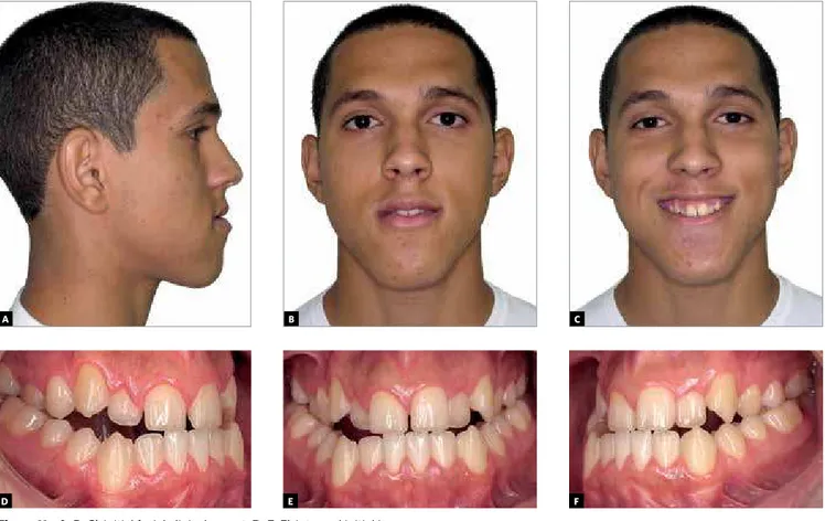 Figure 11 - A, B, C) Initial facial clinical aspect. D, E, F) Intraoral initial images.