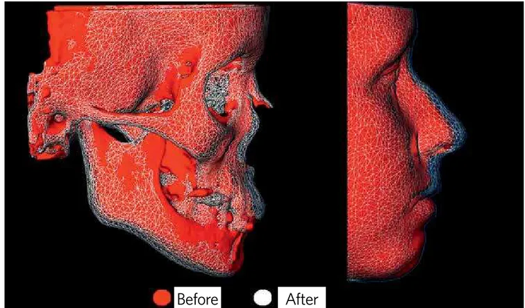 Figure 1 - CBCT before (red) and after (transparent mesh) one year after orthopedic traction, registered on the anterior cranial base.
