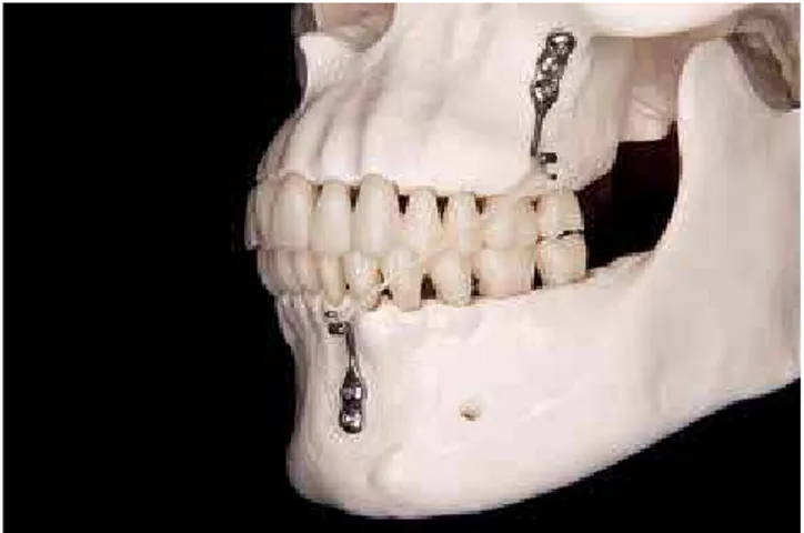 Figure 4 - Elastics are fixed between the miniplates in the infrazygomatic crest  and the other in the lower canine region.