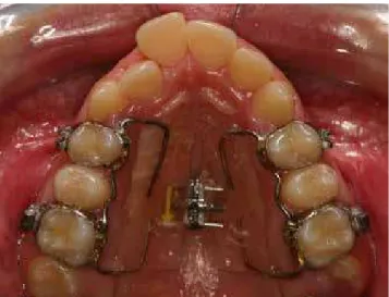 Figure 1 - Patient from group Ha, using Haas appliance.
