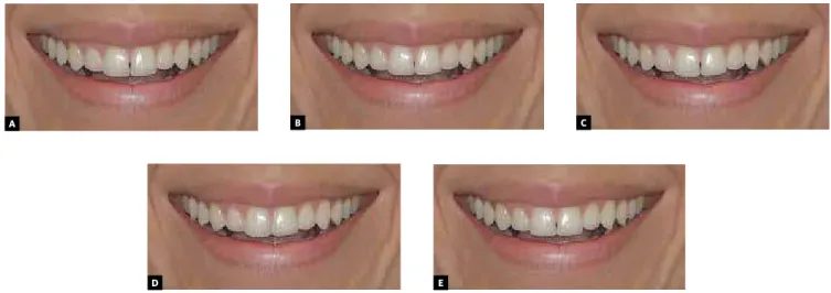 Figure 1 - A) Removal of yellowed stain from mesiobuccal surface of tooth # 26; B) Straightening of  tooth # 22 incisal edge; C) Leveling of tooth #12 gingival margin height; D) Filling of black triangular  space between teeth # 11 and 21; and E) reference