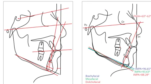Figure 3 - Lines, planes and cephalometric  measurements.
