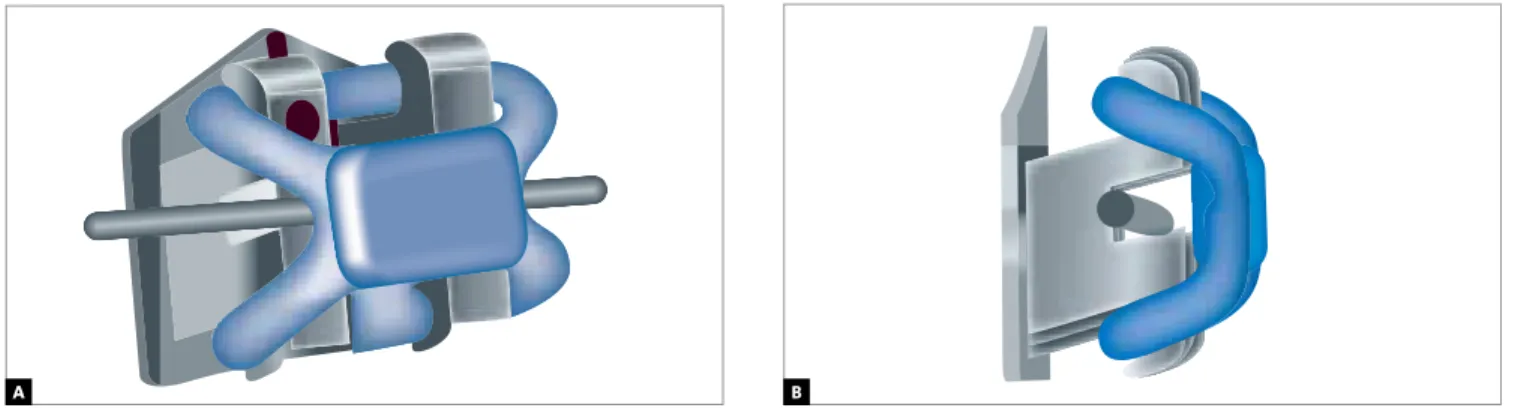Figure 1 - Slide ligatures: A) Frontal view, and B) side view. (Source: Catalog Leone Ortodonzia)