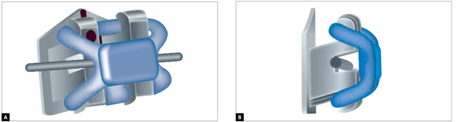 Figure 1 - Slide ligatures: A) Frontal view, and B) side view. (Source: Catalog Leone Ortodonzia)