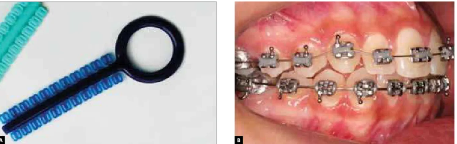 Figure 2 - A) Special 8-shaped elastomeric ligature; B) 8-shaped ligature in the upper arch