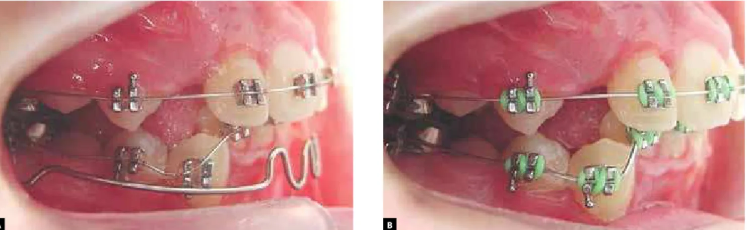 Figure 5 - A) Clinical situation where is not possible to insert a NiTi wire into the bracket slot
