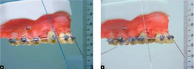 Figure 2 - A) Canine position before retraction with elastic placed on bracket wing; B) retracted canine.