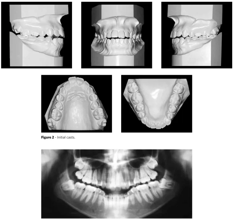 Figure 2 - Initial casts.