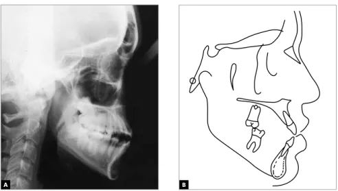 Figure 4 - (A) Initial lateral cephalometric radiograph and (B) cephalometric tracing.