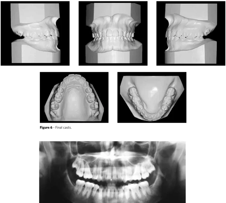 Figure 6 - Final casts.