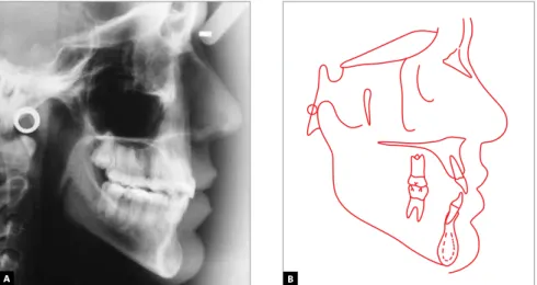 Figure 8 - A) Final lateral cephalometric radiograph and B) cephalometric tracing.