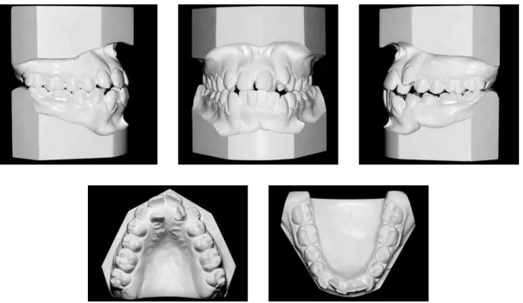 Figure 3 - Initial panoramic X-ray, lateral cephalogram and cephalometric tracing.