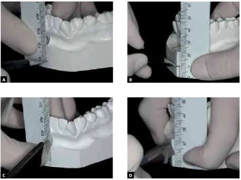Figure 4 - A, B)Record of the initial upper and lower midlines using a ruler and 0.5 mm mechanical  pencil; C, D) grooves with 1 mm width and depth, made with a stylet.