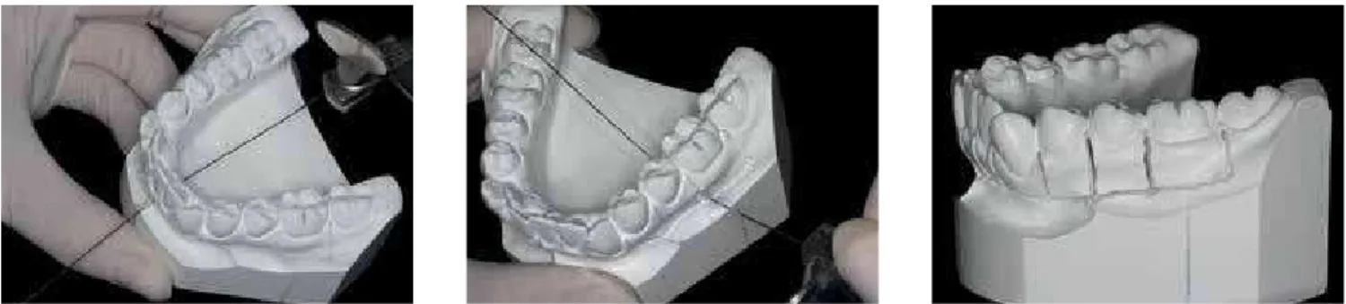 Figure 15 - Horizontal and vertical sections in the lower alveolar ridge of the left quadrant using thin spiral saw mounted on the frame of a bow saw.