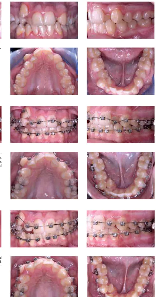 Figure 1 - Patient shows severe crowding in both  arches.