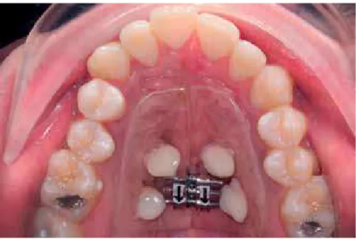 Figure 8 - Pre-expansion: Frontal view. Figure 9 - Post-expansion: Frontal view.