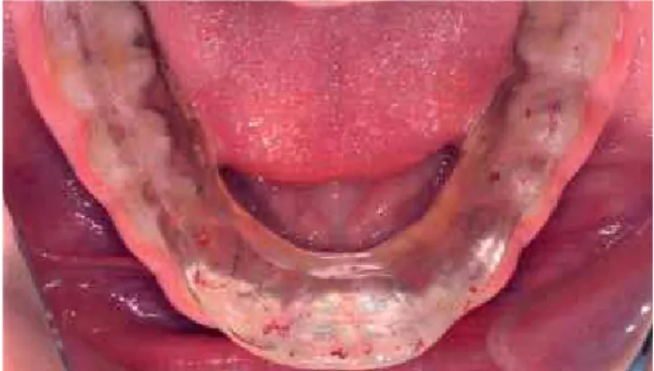 Figure 12 - Patient presented anterior open bite with osteoarthritic joints on  both TMJs.