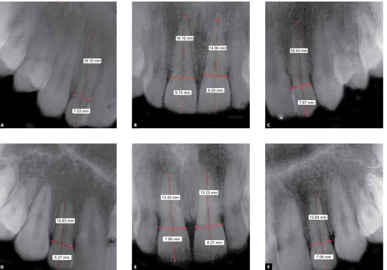 Figure 1 - Digitalized periapical radiographs before (A,B,C) and after (D,E,F) orthodontic treatment with maxillary incisors measurements of crowns and roots.