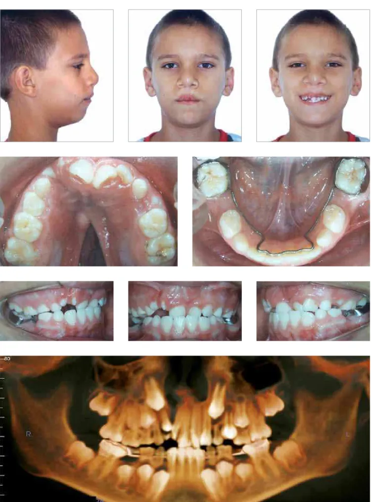 Figure 1 - Patient A’s baseline extra- and intraoral photographs and panoramic CT reconstruction using InVivoDental software.