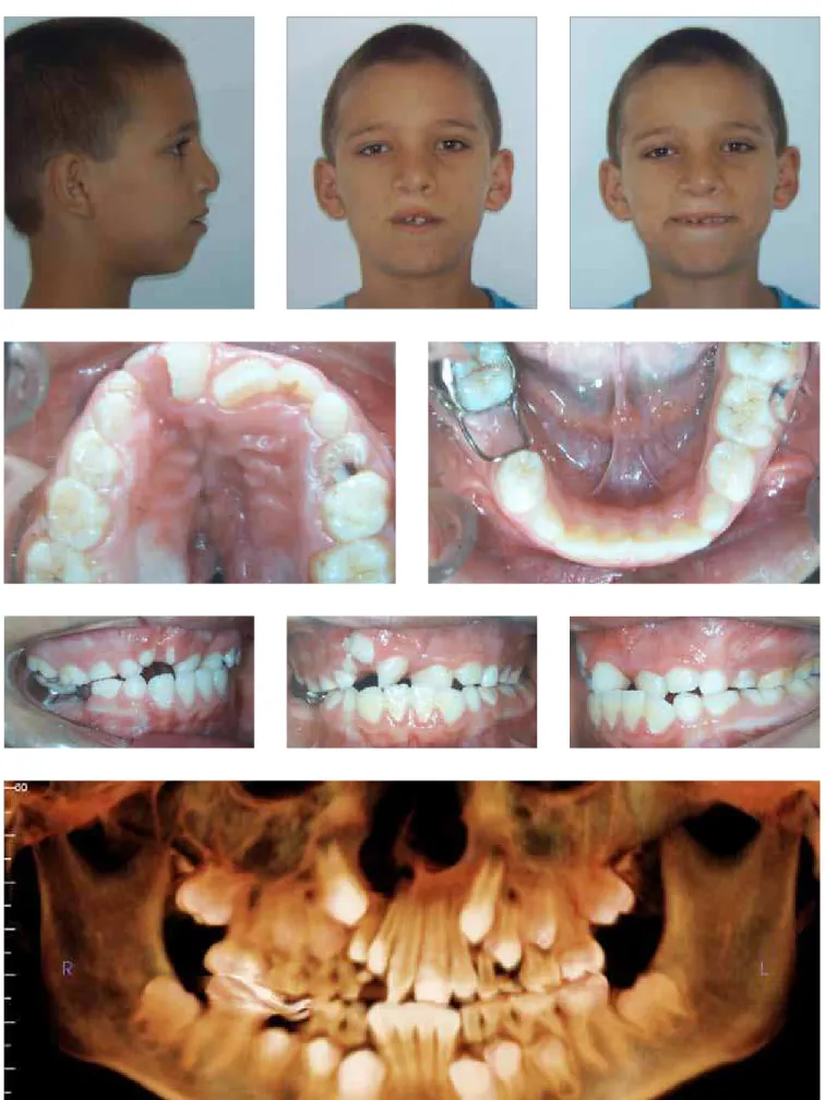 Figure 2 - Patient B’s baseline extra- and intraoral photographs and panoramic CT reconstruction using InVivoDental software.