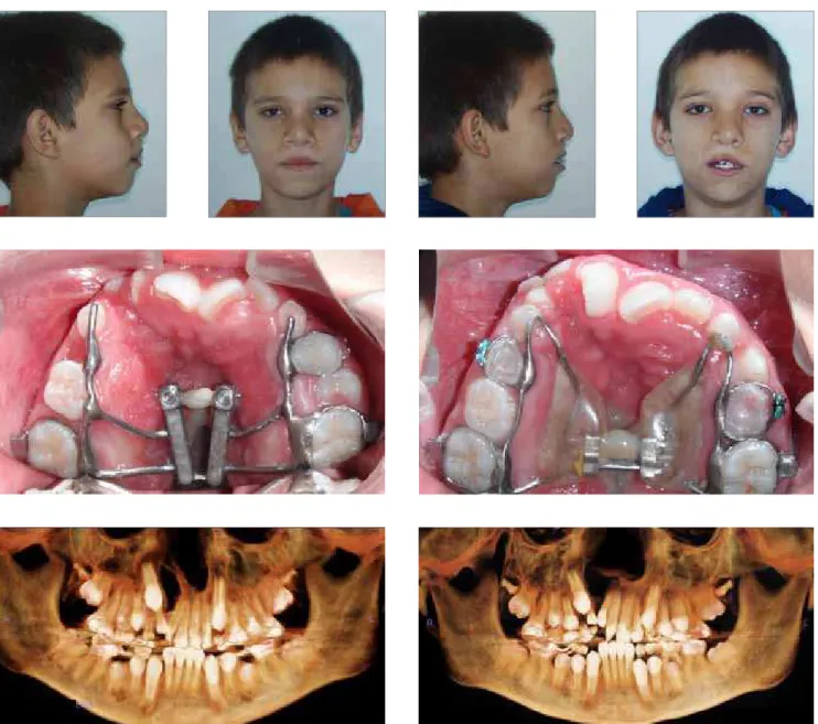 Figure 5 - Extra- and intraoral photographs and panoramic reconstruction of CT images obtained after expansion (patients A and B).