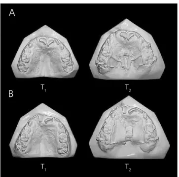 Figure 8 - Comparison between the initial models (T 1 ) and the models ob- ob-tained 6 months after the maxillary expansion (T 2 ) in patients A and B.
