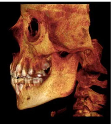 Figure 12 - Three-dimensional facial reconstruction of patient B at 6  months after RME