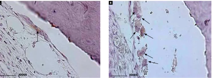 Figure 3 - Photomicrographs of histologic sections in immunohistochemistry (ED1 + ) in cross section of the region situated between the maxillary incisors for os- os-teoclasts (multinucleated giant cells, located within the alveolar bone or at the bone sur