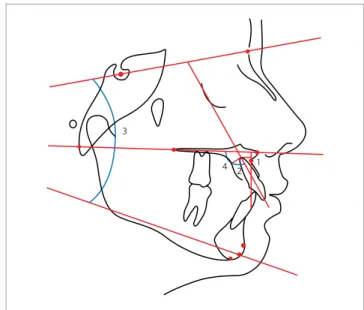 Figure 3  -  Angular and linear measurements used in the study. 1- AAB; 2- PAB.; 