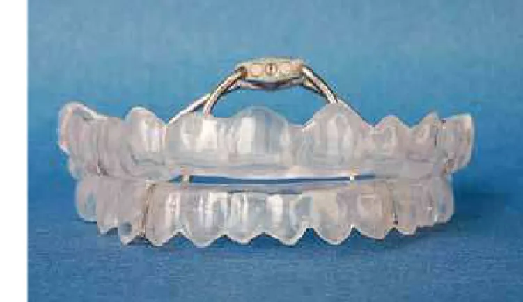 Figure 1 - Adjustable mandibular advancement splints used in patients with OSAHS.