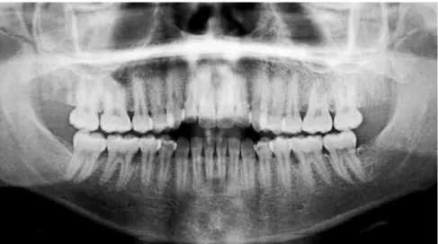 Figure 4 - Initial cephalometric profile radiographs and cephalometric tracings.